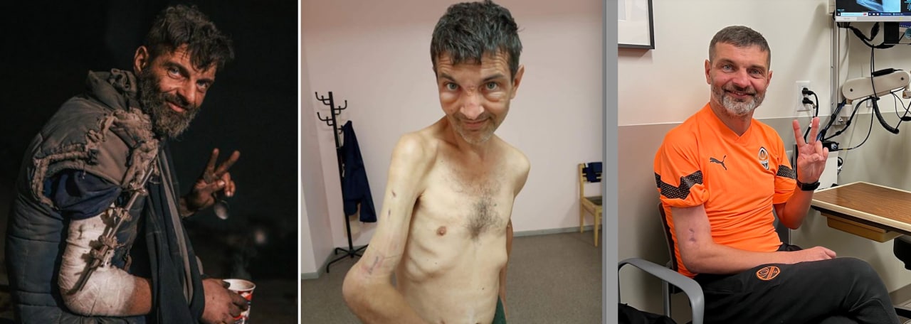 FOTO: Soldatul ucrainean Mihailo Dianov, care a fost luat prizonier de ruși, operat în SUA: Mâna lui va funcționa pe deplin