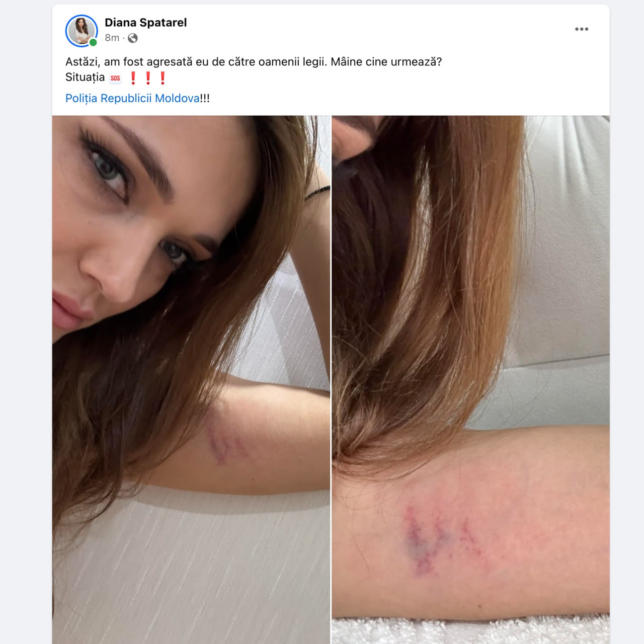 "Agresați ~~în grup~~ la pachet": Partenera lui Alexei Lungu scrie pe facebook că și ea a fost agresată azi de către Poliție, prezentând câteva vânătăi pe mână